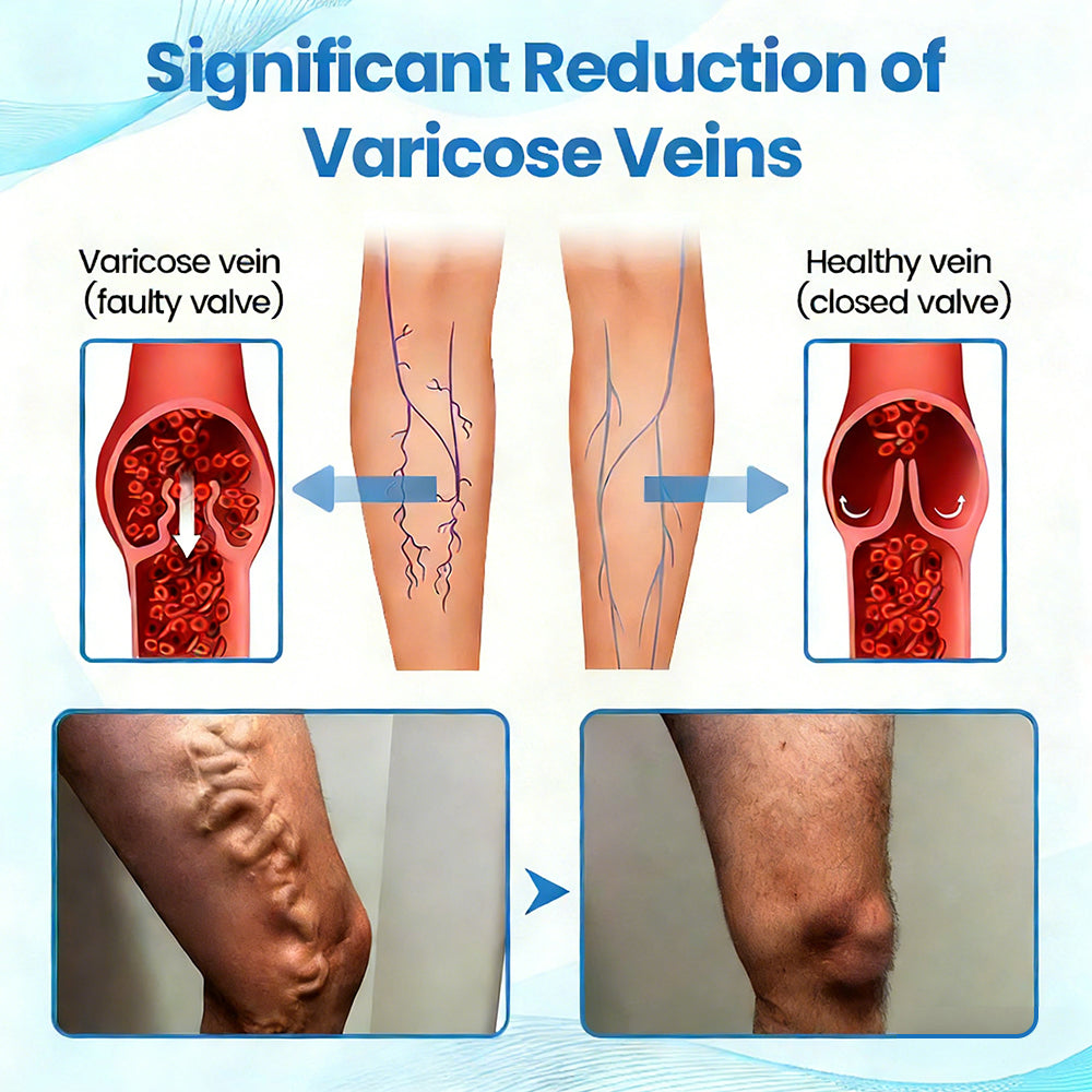 🇦🇺✅✅GFOUK® VascuCare Vein Healing Spray(Designed for Varicose veins, Spider veins, Deep vein Thrombosis, Chronic venous insufficiency, Venous ulcers, Thrombophlebitis and other venous issues)