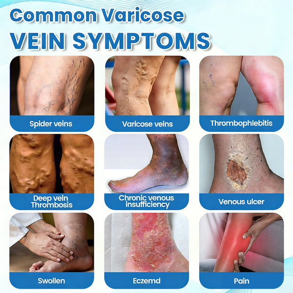 🇦🇺✅✅GFOUK® VascuCare Vein Healing Spray(Designed for Varicose veins, Spider veins, Deep vein Thrombosis, Chronic venous insufficiency, Venous ulcers, Thrombophlebitis and other venous issues)