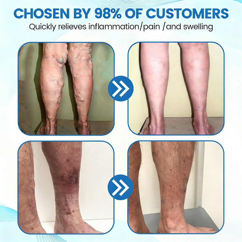 🇦🇺✅✅GFOUK® VascuCare Vein Healing Spray(Designed for Varicose veins, Spider veins, Deep vein Thrombosis, Chronic venous insufficiency, Venous ulcers, Thrombophlebitis and other venous issues)