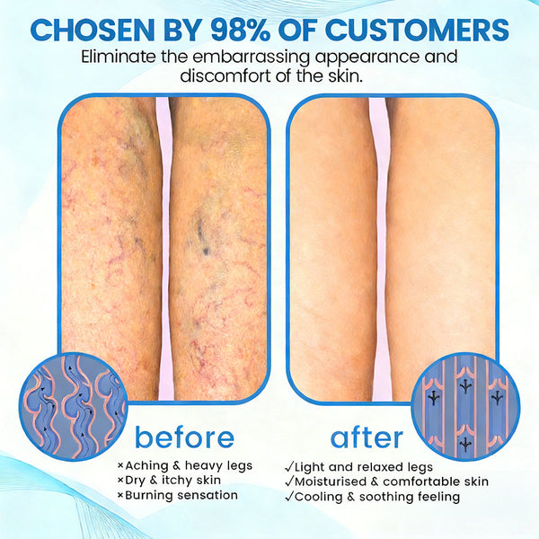🇦🇺✅✅GFOUK® VascuCare Vein Healing Spray(Designed for Varicose veins, Spider veins, Deep vein Thrombosis, Chronic venous insufficiency, Venous ulcers, Thrombophlebitis and other venous issues)