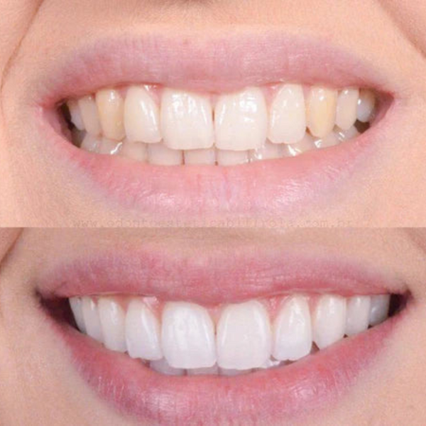 GlowSmile™ | Your Brightest Smile, Instantly!