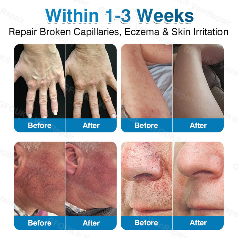 🇬🇧🥇👨‍⚕️⭐GFOUK® VeinRepair Microneedle Patch Roll⚡Instant Relief, Long-Term Results