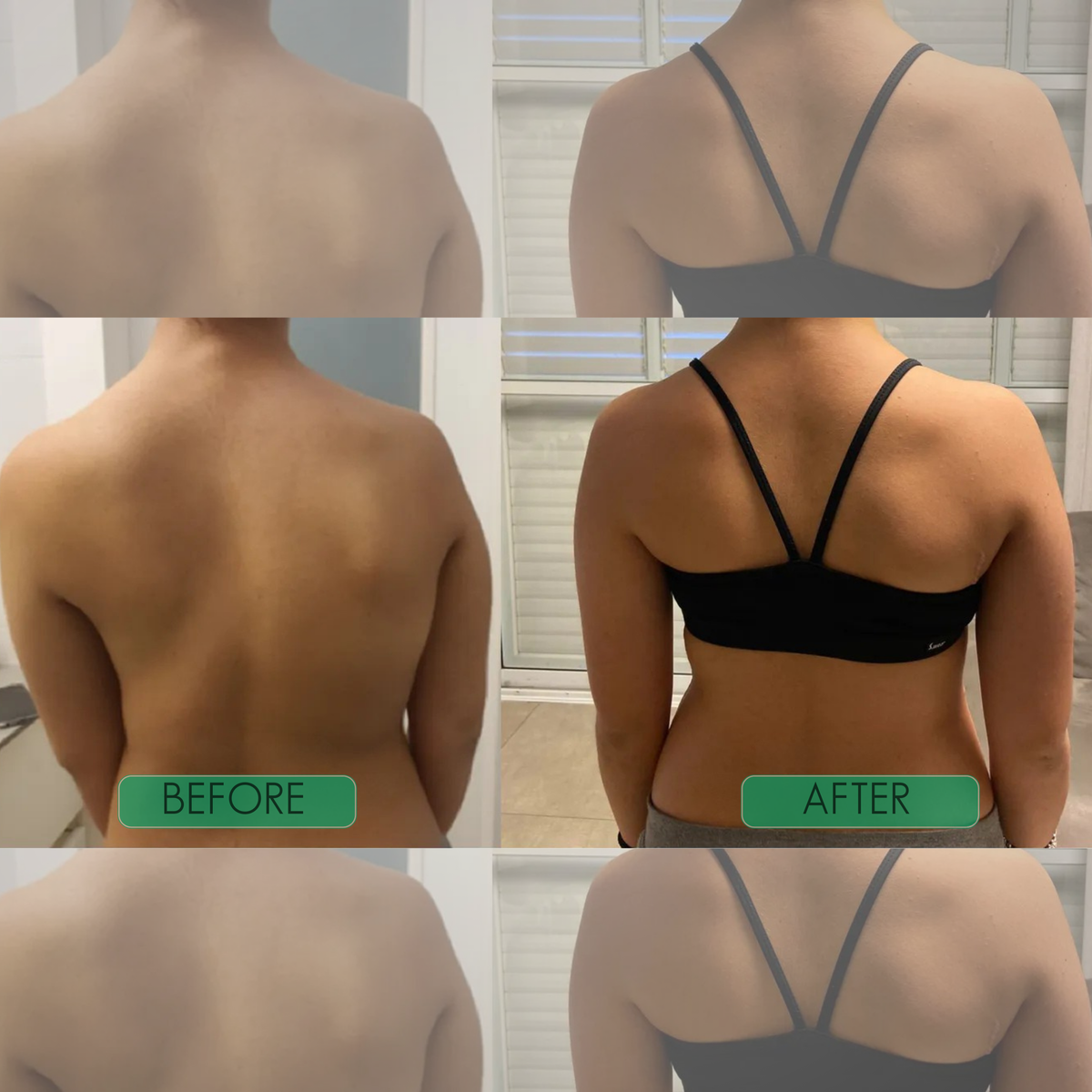 SpineEase™ Posture Corrector for Straighter Everyday Alignment