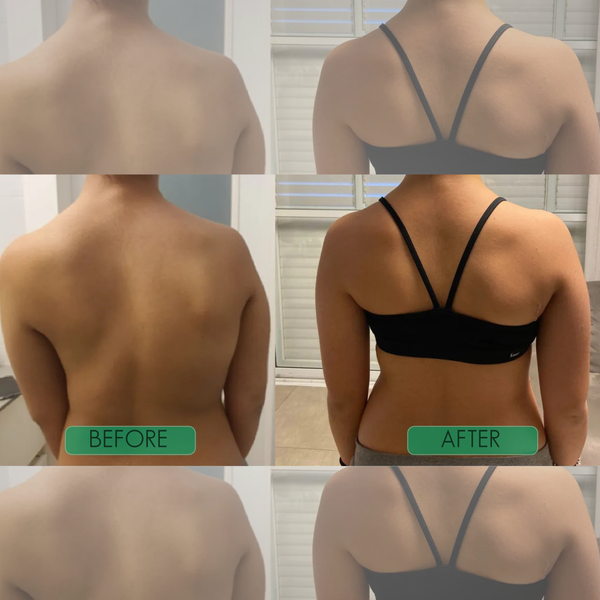 SpineEase™ Posture Corrector for Straighter Everyday Alignment