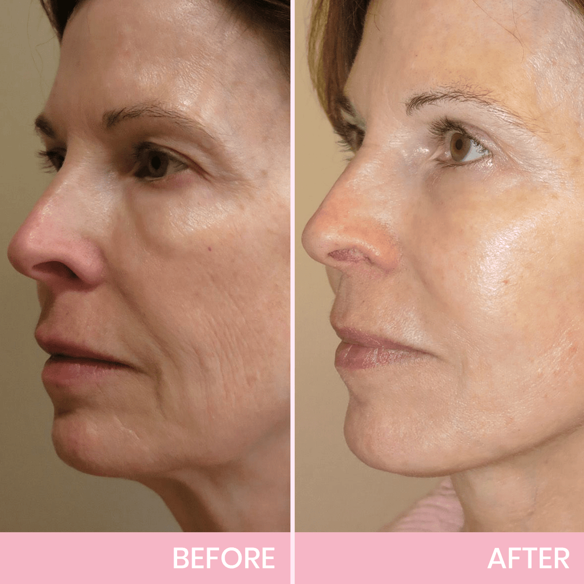V Face-Lifting Invisible Tape
