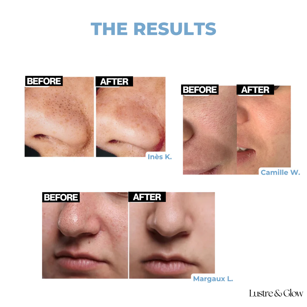 SkinRefine™ | Serum That Targets Clogged Pores For Flawless Skin
