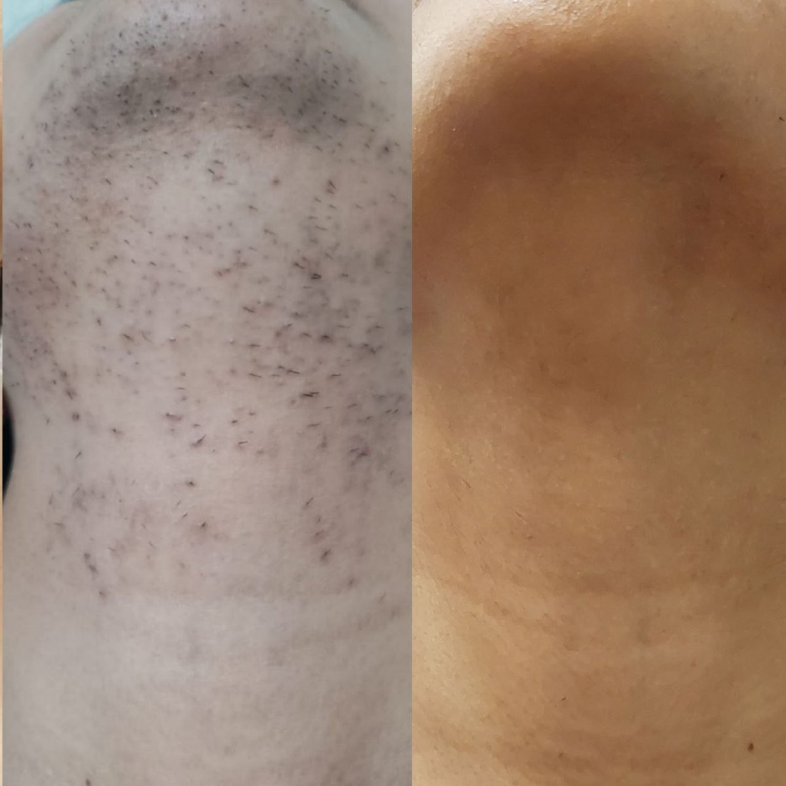 Hair Removal Oil