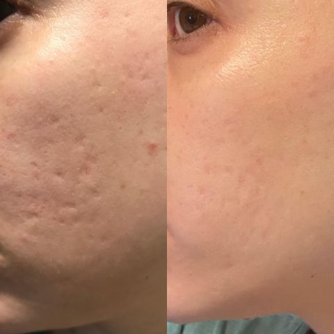 NuSkin™ – Faltenfreie Haut für selbstbewusstes, strahlendes, jugendliches Auftreten [2 + 2 Gratis]