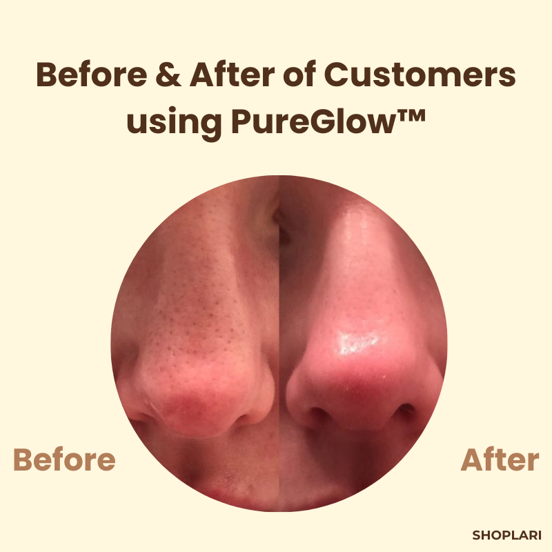 PureGlow™ TeaTherapy Soothing Skin Relief in just Few Weeks