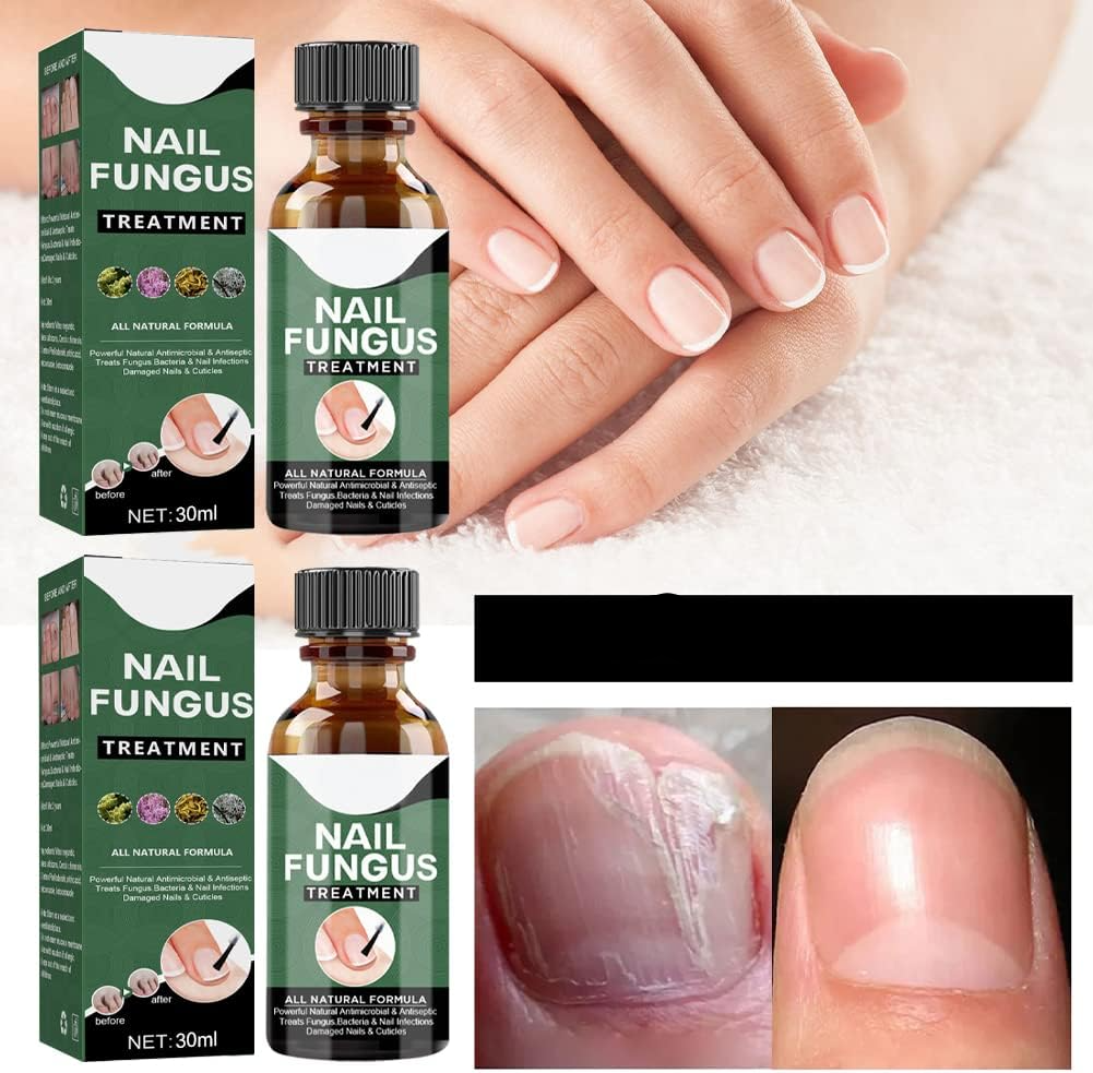 PureNail™ – Nagelpilz-Reparaturserum, heilt, restauriert & schützt beschädigte Nägel effektiv [50% Rabatt]