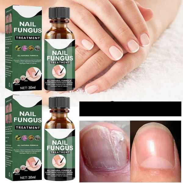 PureNail™ – Nagelpilz-Reparaturserum, heilt, restauriert & schützt beschädigte Nägel effektiv [50% Rabatt]