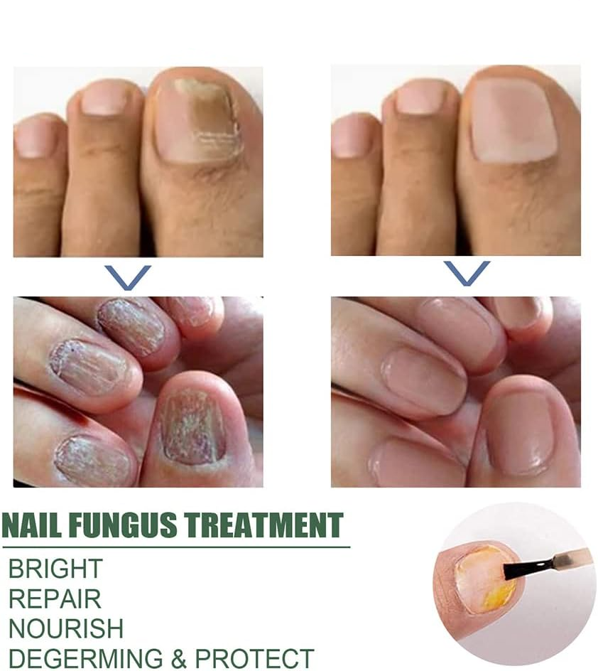 PureNail™ – Nagelpilz-Reparaturserum, heilt, restauriert & schützt beschädigte Nägel effektiv [50% Rabatt]