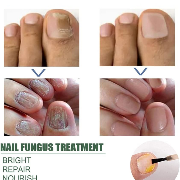 PureNail™ – Nagelpilz-Reparaturserum, heilt, restauriert & schützt beschädigte Nägel effektiv [50% Rabatt]