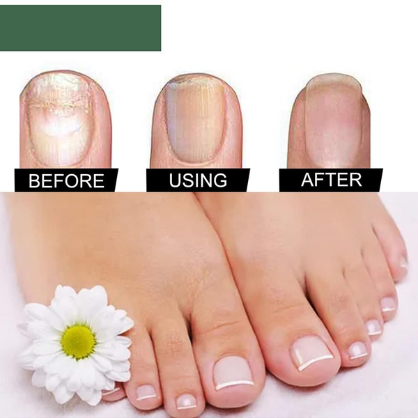 PureNail™ – Nagelpilz-Reparaturserum, heilt, restauriert & schützt beschädigte Nägel effektiv [50% Rabatt]