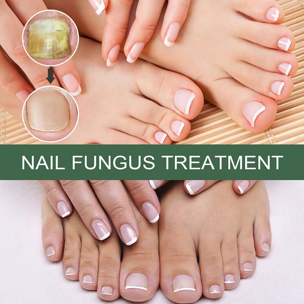 PureNail™ – Nagelpilz-Reparaturserum, heilt, restauriert & schützt beschädigte Nägel effektiv [50% Rabatt]