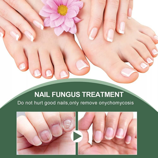 PureNail™ – Nagelpilz-Reparaturserum, heilt, restauriert & schützt beschädigte Nägel effektiv [50% Rabatt]
