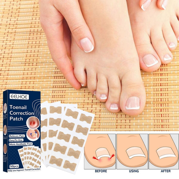 NailLift™ – Korrektur-Pads für eingewachsene Zehennägel, einfach anzuwenden und schützend [1 + 1 Gratis]