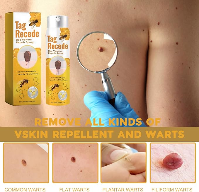 TagAway™ – Effektive Entfernung von Warzen und Hautwucherungen schnell und sicher [50% Rabatt]